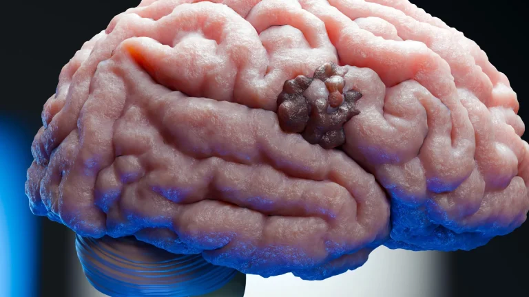 a-seven-decade-old-blood-pressure-medication-unveils-novel-mechanisms-against-aggressive-brain-tumors