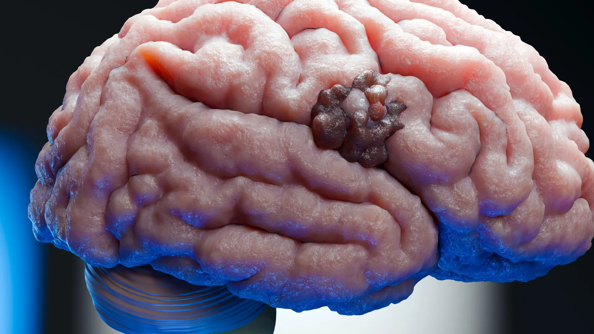 a-seven-decade-old-blood-pressure-medication-unveils-novel-mechanisms-against-aggressive-brain-tumors