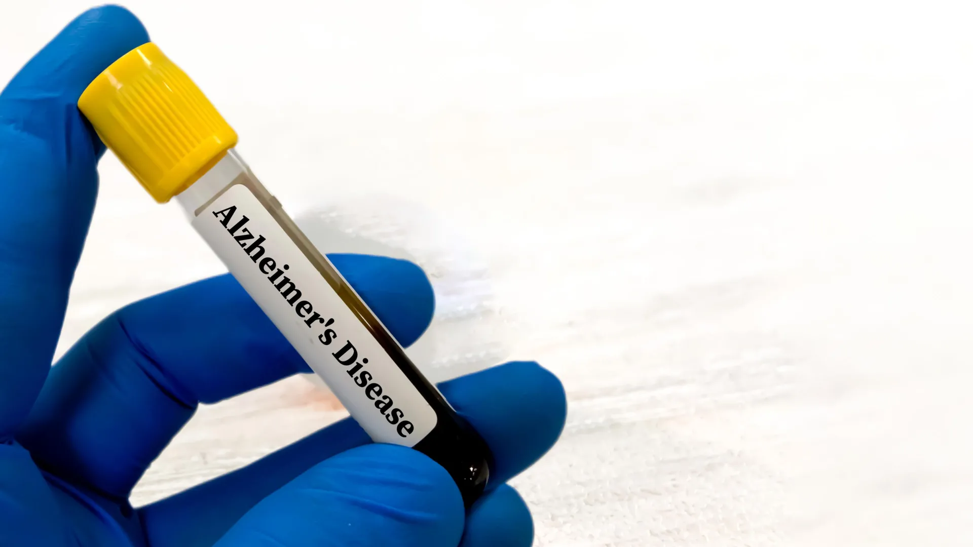 navigating-alzheimers-diagnostics-the-unseen-influence-of-renal-health-on-blood-biomarker-accuracy