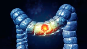 elevated-intestinal-rigidity-identified-as-potential-driver-of-premature-colorectal-malignancies