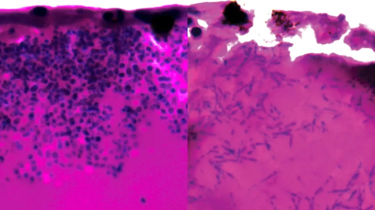 unveiling-a-critical-metabolic-pathway-in-a-resurgent-fungal-threat-offers-novel-therapeutic-avenues