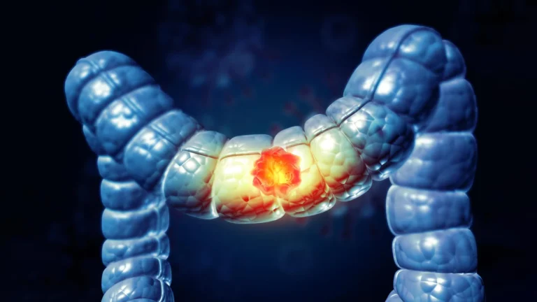 immune-cell-subtypes-dictate-colorectal-cancer-outcomes-paving-way-for-precision-immunotherapy