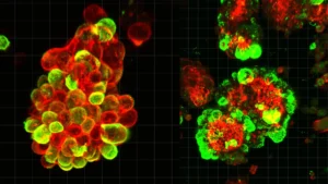 unraveling-the-aggressive-spread-ovarian-cancers-cellular-conspiracy-revealed