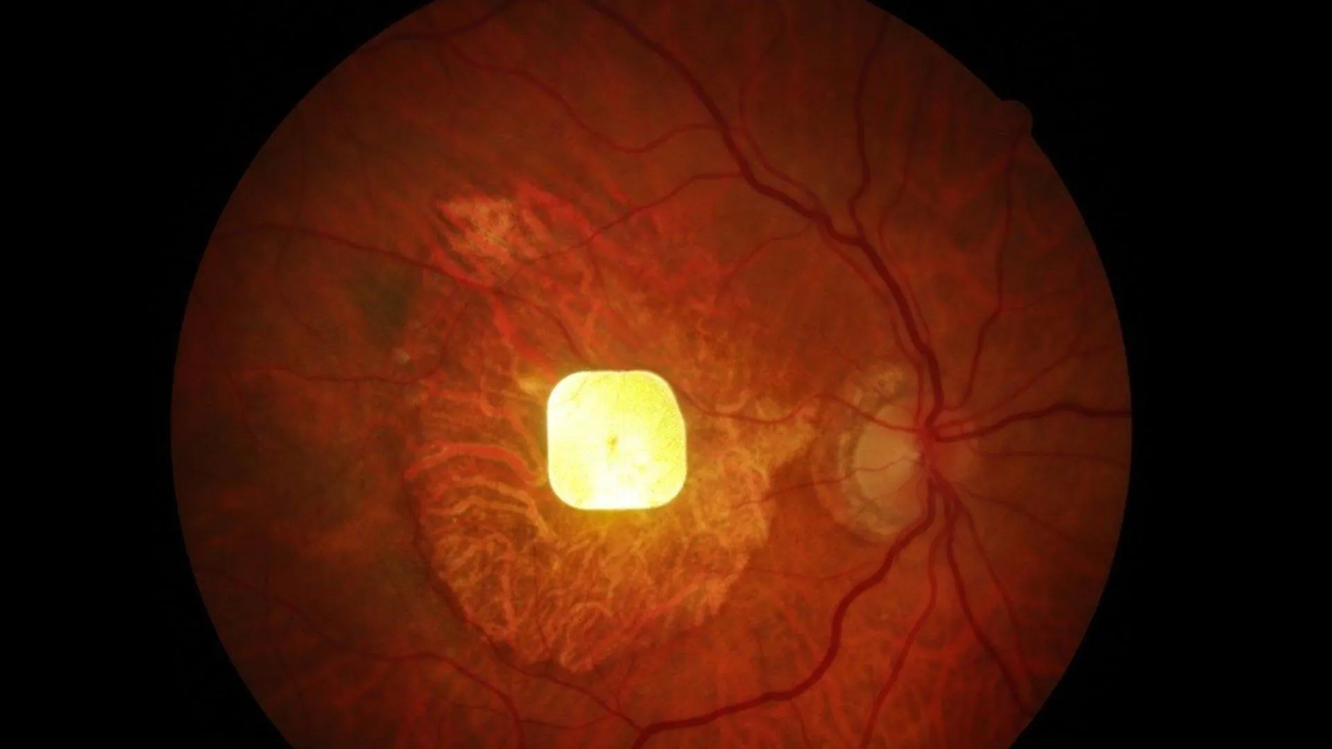 breakthrough-in-visual-prosthetics-retinal-chip-restores-central-sight-for-advanced-macular-degeneration-patients