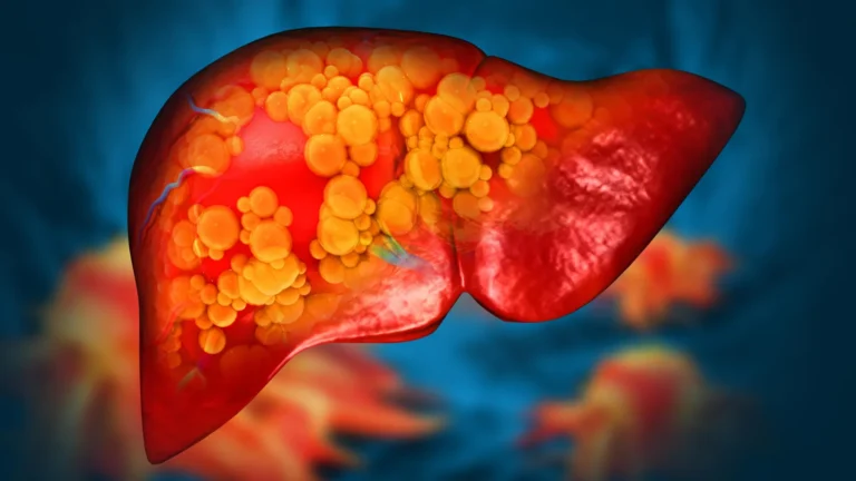 genomic-revelation-researchers-uncover-direct-genetic-driver-for-widespread-fatty-liver-disease