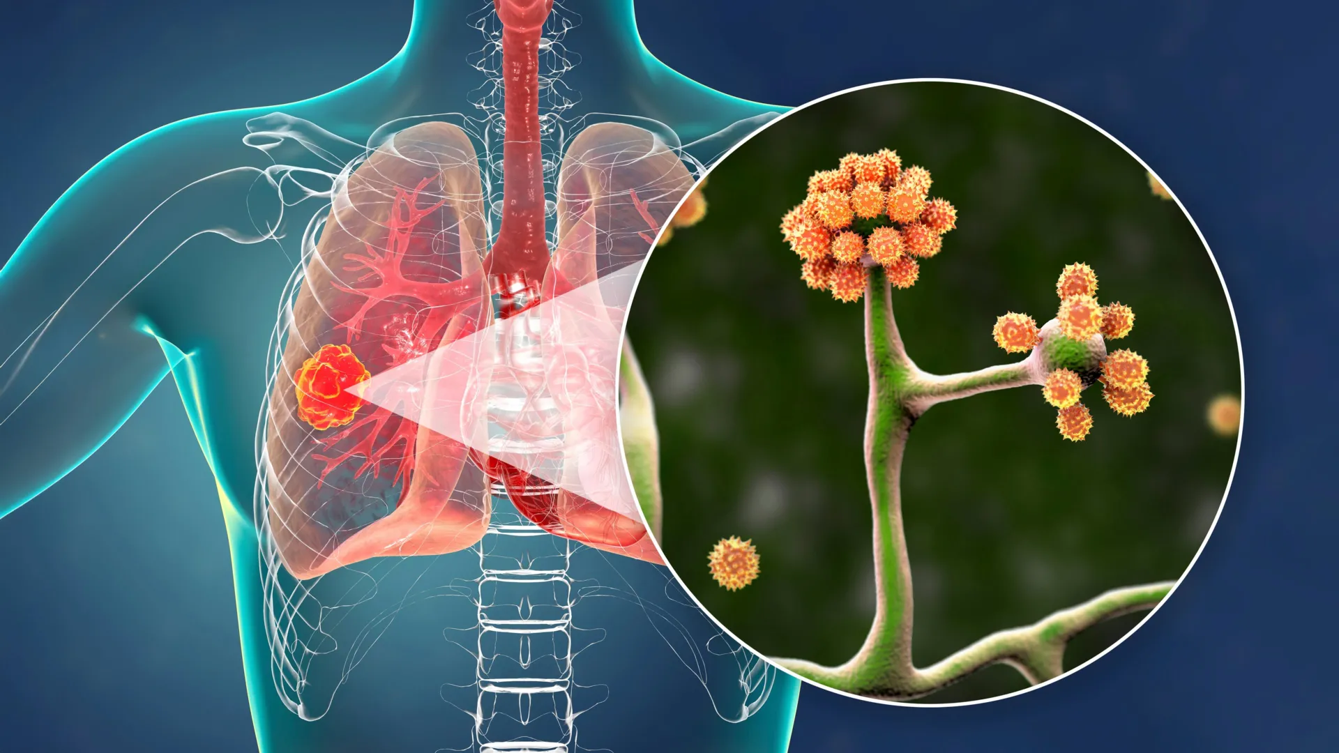human-albumin-unveiled-as-critical-innate-defense-against-deadly-mucormycosis