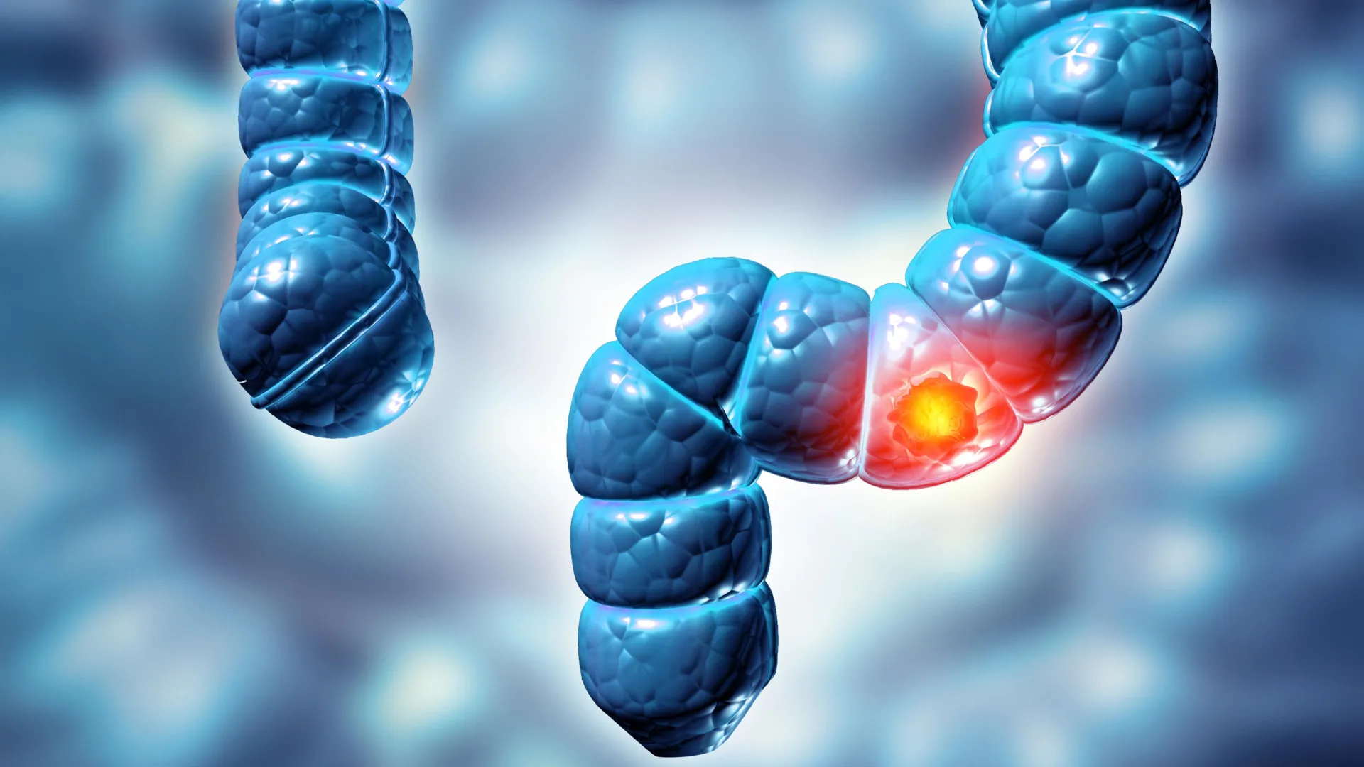 synchronous-colonic-polyps-a-fivefold-escalation-in-precancerous-risk-demands-tailored-surveillance