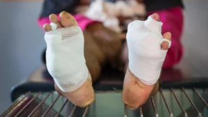 targeting-cellular-oxygen-deprivation-a-novel-gels-promise-in-chronic-wound-management