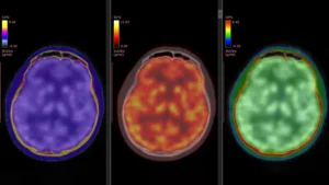 unlocking-the-neural-pathways-of-rapid-antidepressant-action-groundbreaking-brain-imaging-reveals-ketamines-mechanism