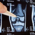 decade-long-inquiry-reveals-widespread-knee-surgery-lacks-efficacy-and-may-exacerbate-osteoarthritis-progression