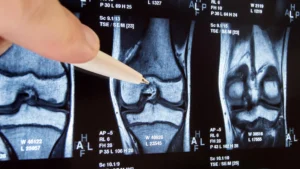 decade-long-inquiry-reveals-widespread-knee-surgery-lacks-efficacy-and-may-exacerbate-osteoarthritis-progression
