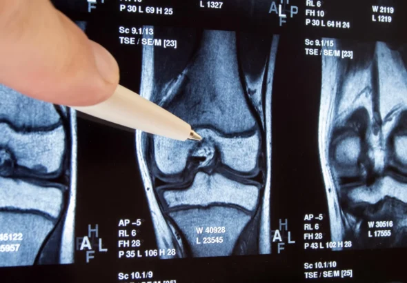 decade-long-inquiry-reveals-widespread-knee-surgery-lacks-efficacy-and-may-exacerbate-osteoarthritis-progression