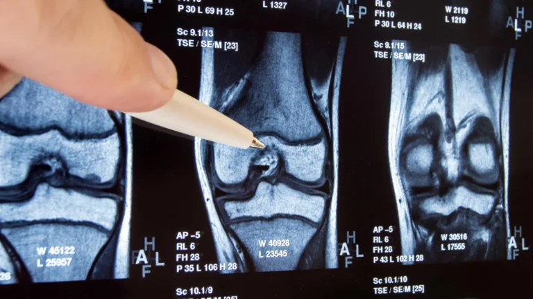 decade-long-inquiry-reveals-widespread-knee-surgery-lacks-efficacy-and-may-exacerbate-osteoarthritis-progression