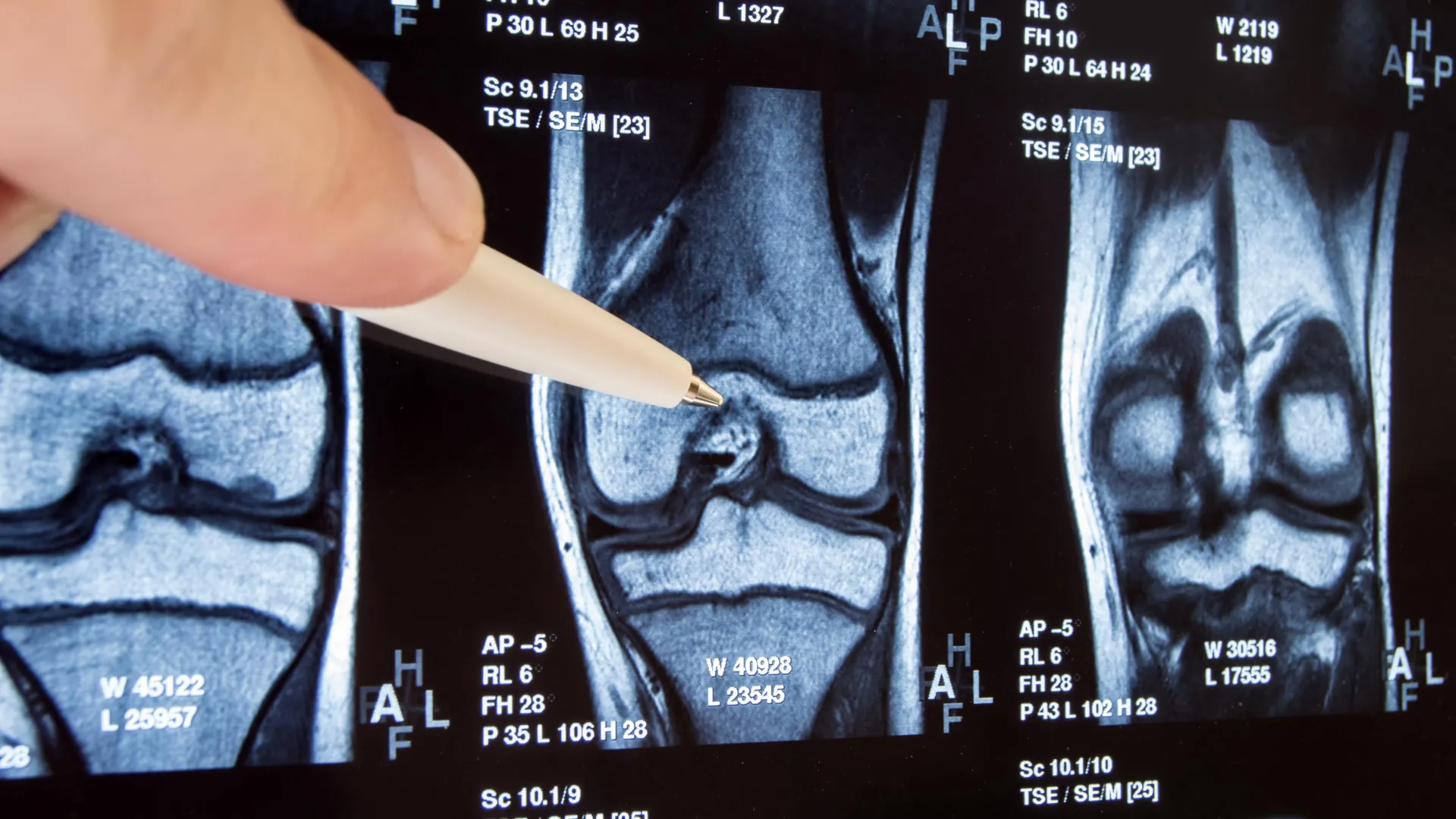 decade-long-inquiry-reveals-widespread-knee-surgery-lacks-efficacy-and-may-exacerbate-osteoarthritis-progression