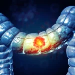 pre-surgical-immunotherapy-shows-remarkable-durability-in-advanced-colorectal-cancer-patients