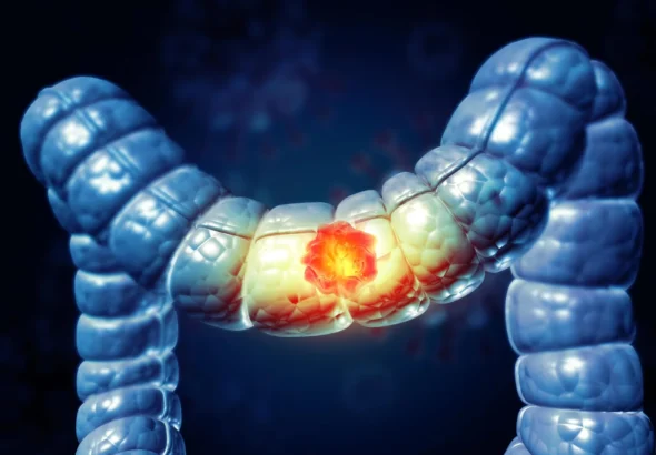 pre-surgical-immunotherapy-shows-remarkable-durability-in-advanced-colorectal-cancer-patients