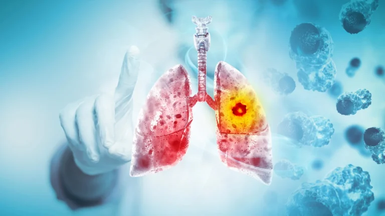 diet-environment-and-disease-unveiling-new-insights-into-early-onset-lung-cancer-risk