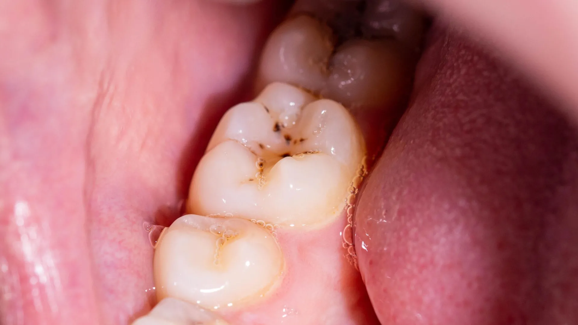 novel-biomimetic-gel-offers-potential-for-complete-enamel-regeneration-and-enhanced-dental-resilience