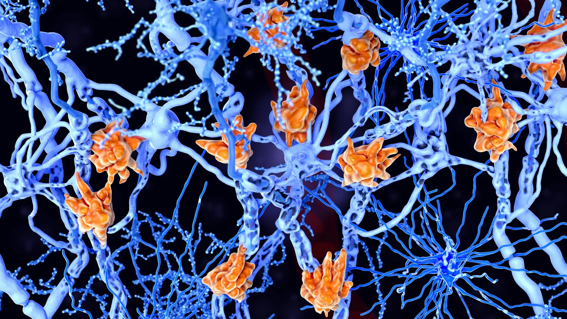 novel-brain-cell-fat-accumulation-linked-to-aggravated-multiple-sclerosis-progression