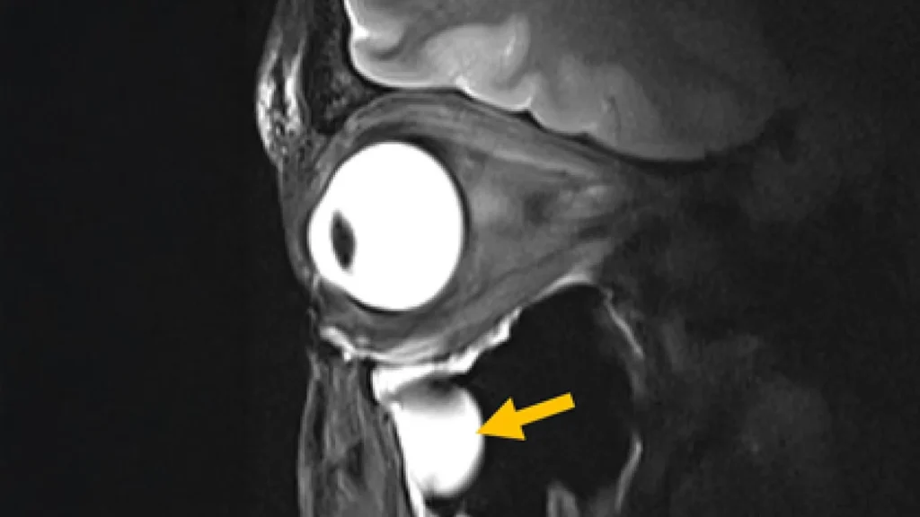 revolutionary-metamaterial-antenna-unlocks-unprecedented-clarity-in-deep-brain-and-ocular-magnetic-resonance-imaging