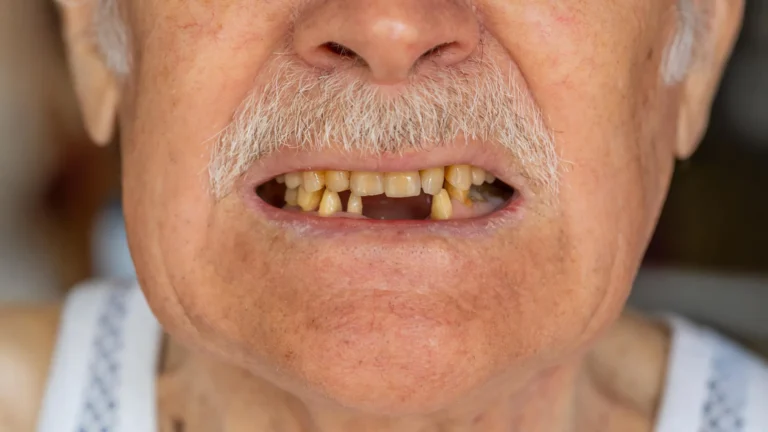 evaluating-oral-health-metrics-to-forecast-long-term-survival-after-pancreatic-cancer-resection