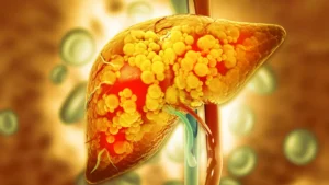 ketogenic-eating-plan-demonstrates-superior-efficacy-in-reducing-hepatic-steatosis-and-reversing-prediabetes-markers-in-clinical-investigation