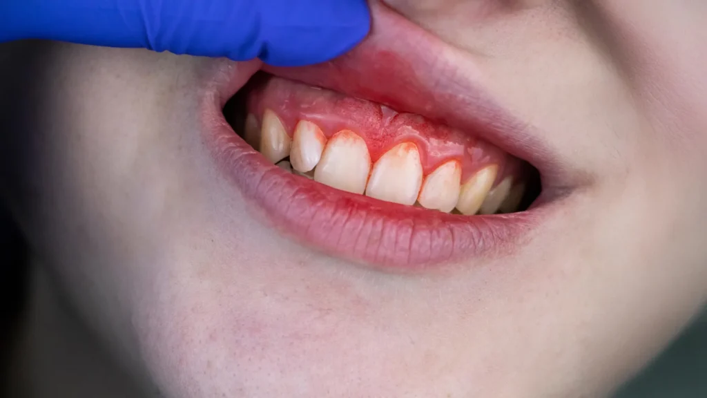 novel-dietary-supplementation-regimen-demonstrates-efficacy-comparable-to-antibiotics-in-advanced-gum-disease-management