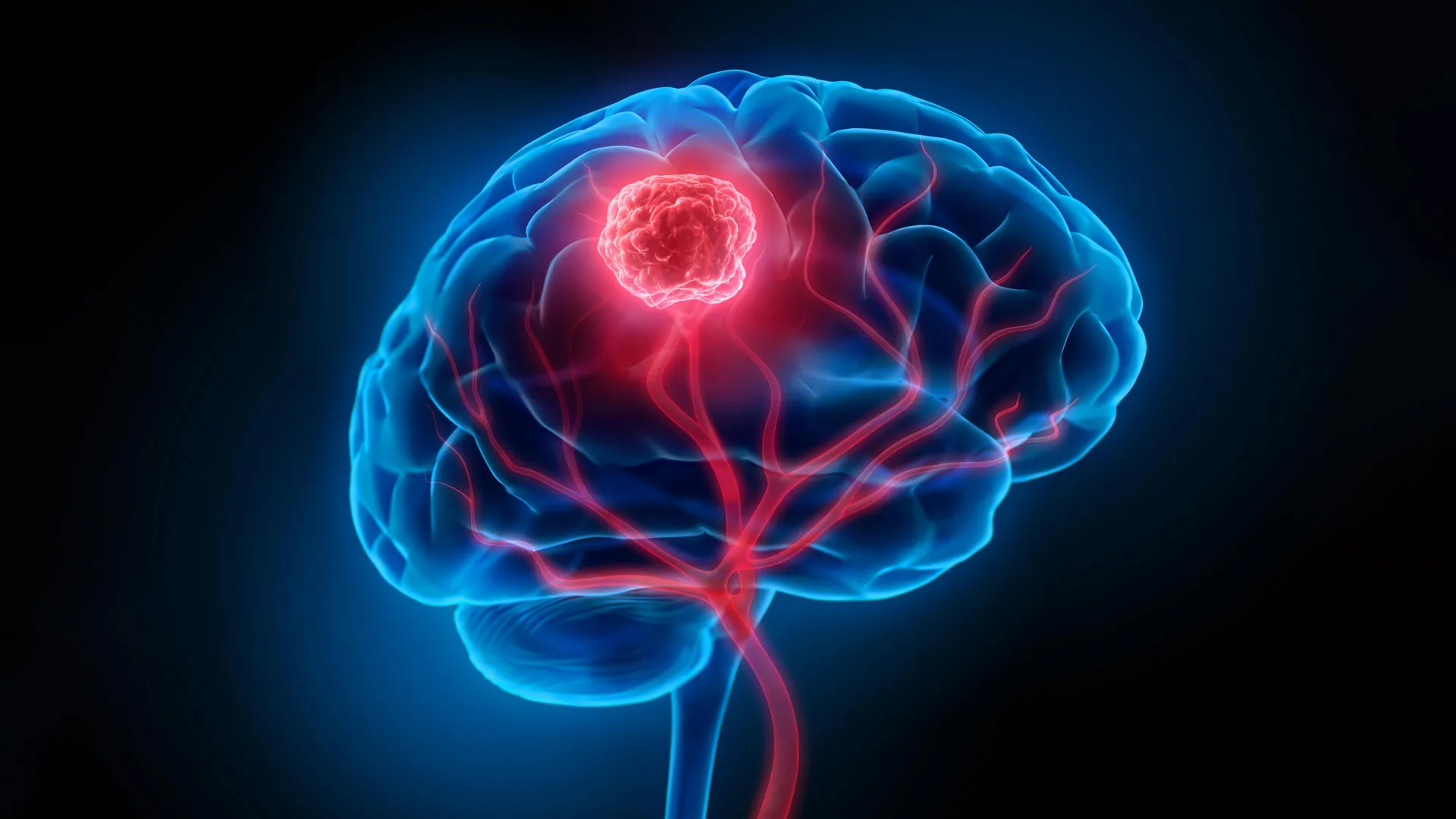 novel-nanoparticle-system-illuminates-and-eradicates-residual-brain-tumors