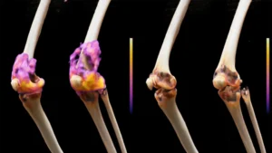 revolutionary-immunotherapy-shows-promise-in-eradicating-severe-rheumatoid-arthritis-symptoms