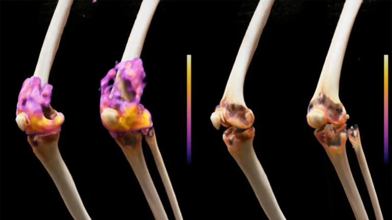 revolutionary-immunotherapy-shows-promise-in-eradicating-severe-rheumatoid-arthritis-symptoms