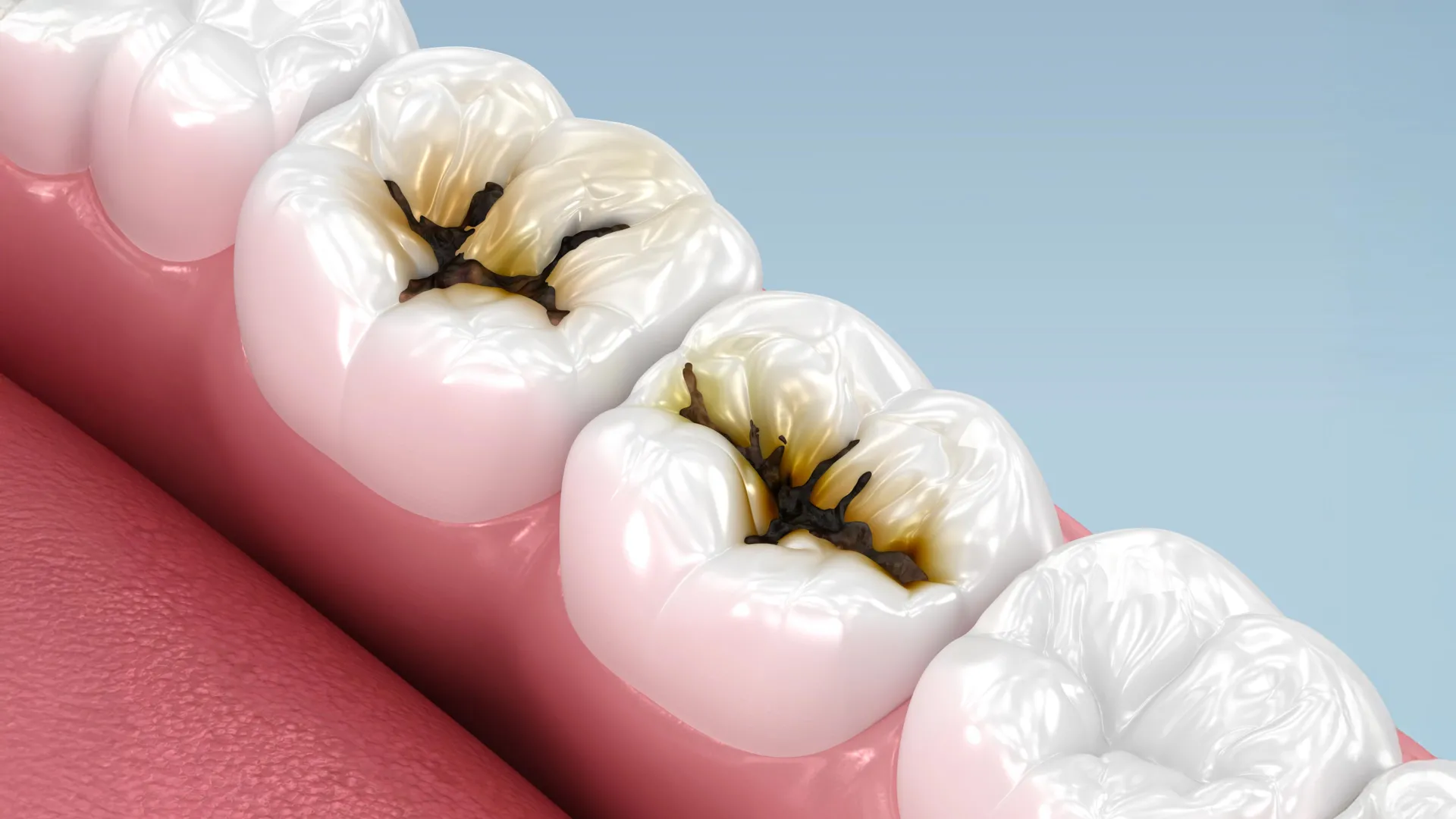 revolutionary-topical-solution-halts-early-childhood-tooth-decay-offering-non-invasive-alternative-to-fillings