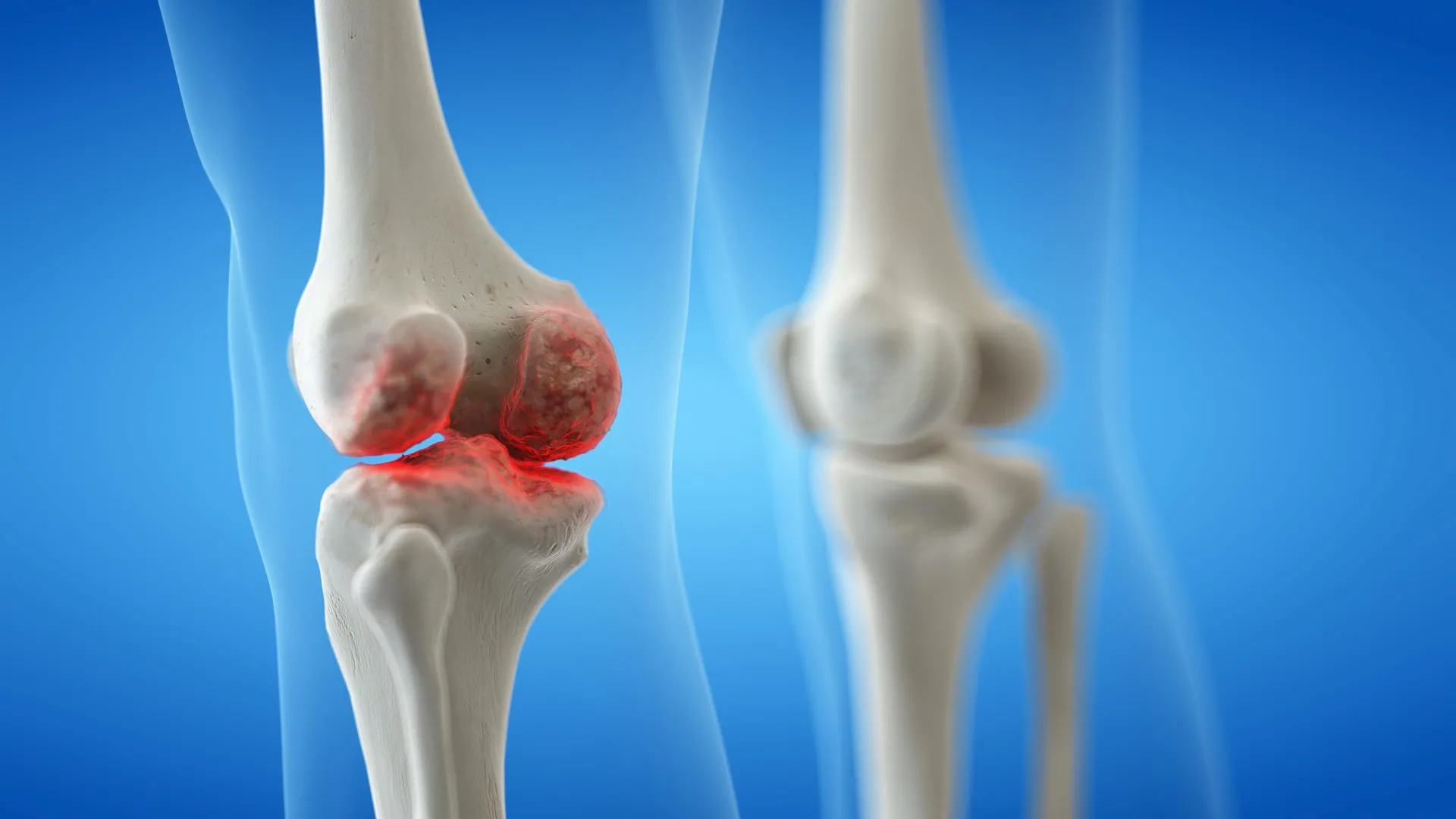safeguarding-your-knees-understanding-preventing-and-managing-osteoarthritis