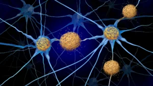 mapping-alzheimers-onset-structural-brain-changes-detected-years-before-amyloid-plaque-formation