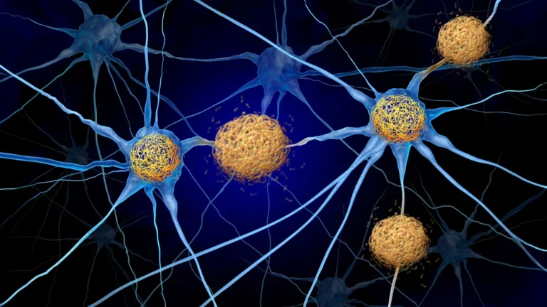 mapping-alzheimers-onset-structural-brain-changes-detected-years-before-amyloid-plaque-formation