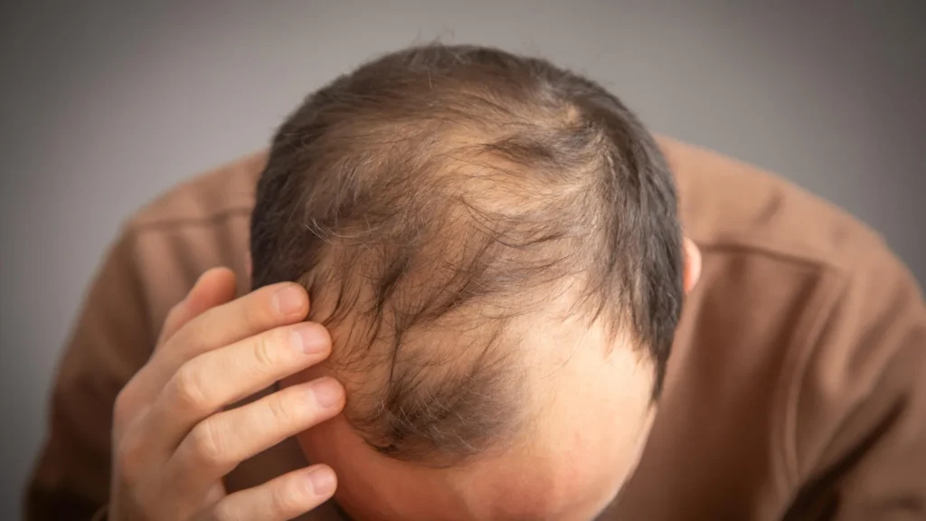 unpacking-the-genetic-link-how-glp-1-medications-may-influence-male-pattern-baldness-risk