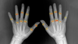 unraveling-rheumatoid-arthritis-how-prenatal-joint-development-shapes-disease-susceptibility