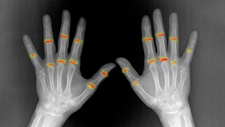 unraveling-rheumatoid-arthritis-how-prenatal-joint-development-shapes-disease-susceptibility