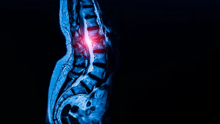 unveiling-the-cellular-architects-of-connective-tissues-and-their-link-to-spinal-narrowing