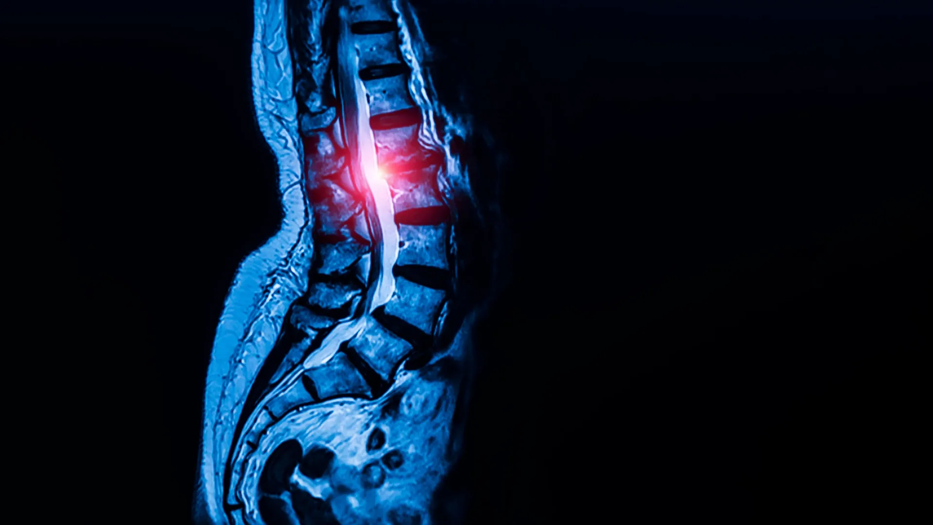 unveiling-the-cellular-architects-of-connective-tissues-and-their-link-to-spinal-narrowing